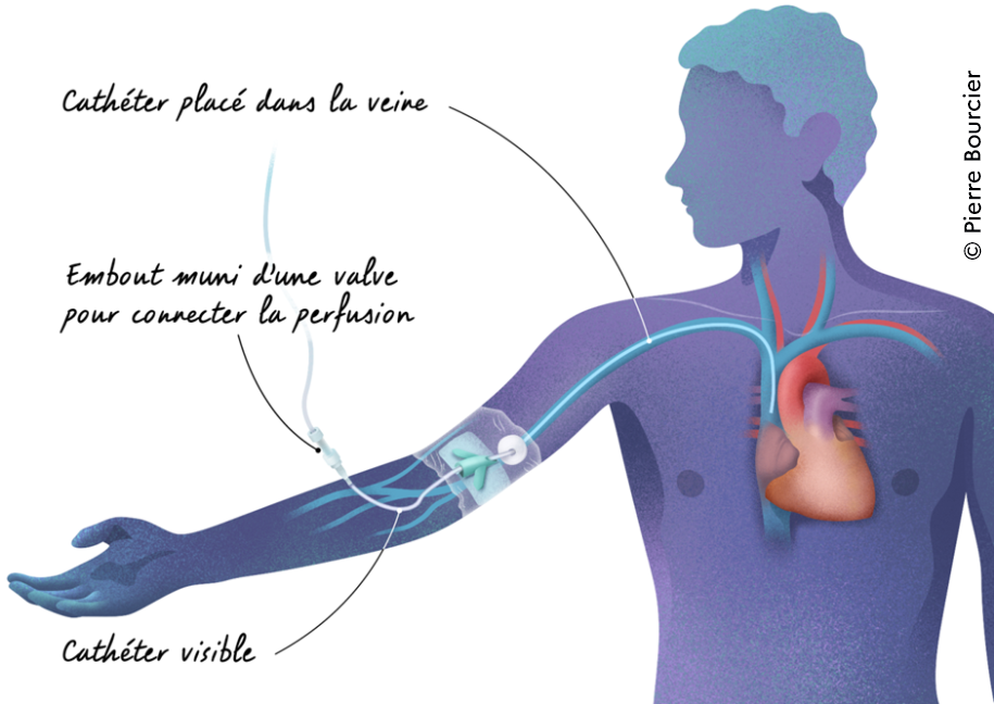 Pourquoi utiliser un cathéter central ou une chambre à cathéter