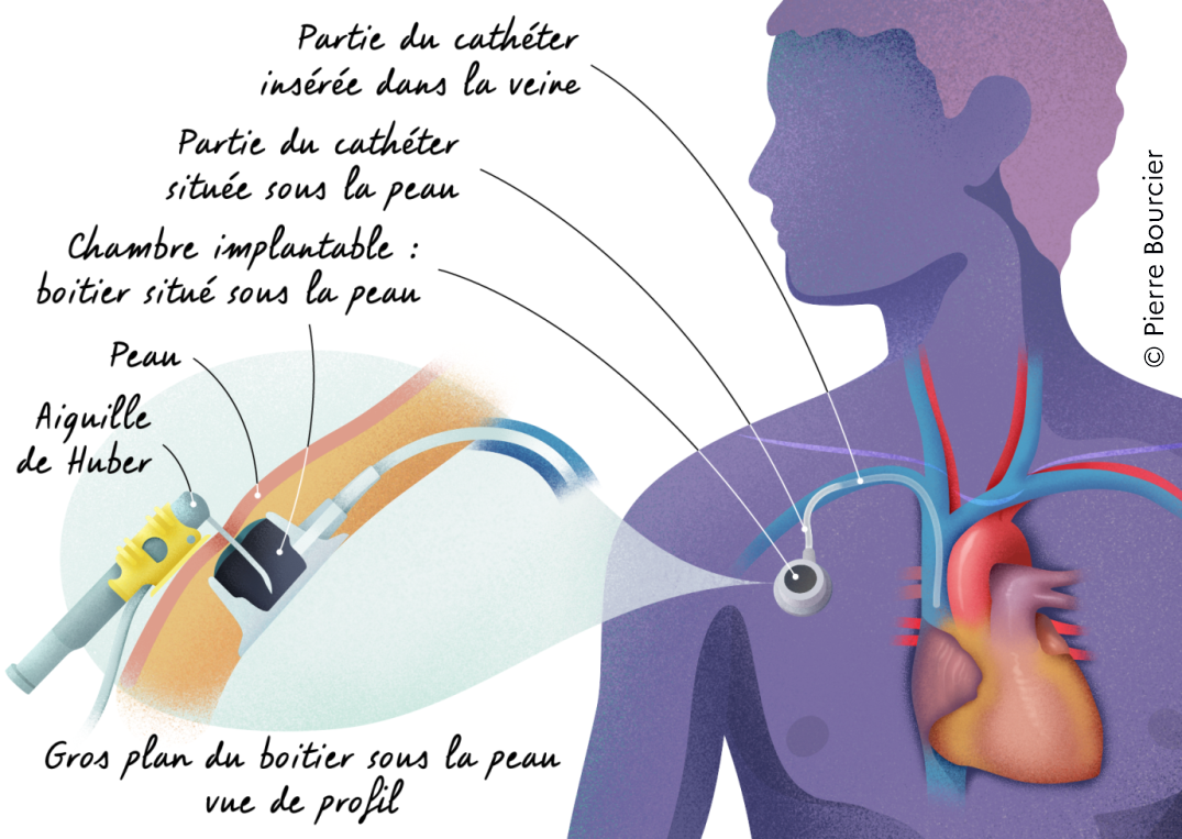 Pourquoi utiliser un cathéter central ou une chambre à cathéter implantable ? Traitements