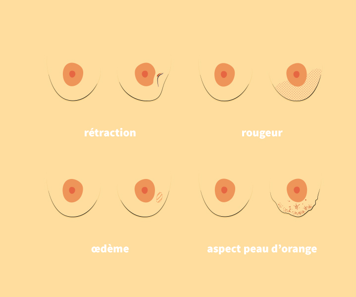 Rétractation sur le côté du sein / Rougeur / Oedème / Aspect peau d'orange