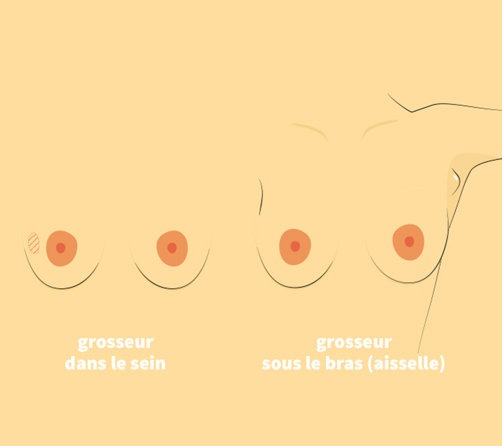 Grosseur dans le sein ou sous le bras (aisselle)