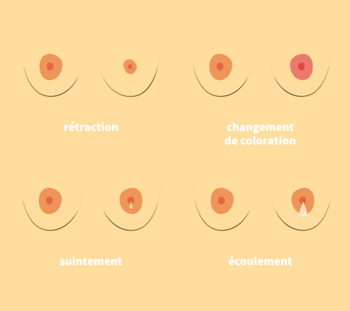 Rétractation du téton / Changement de coloration / Suintement / Écoulement