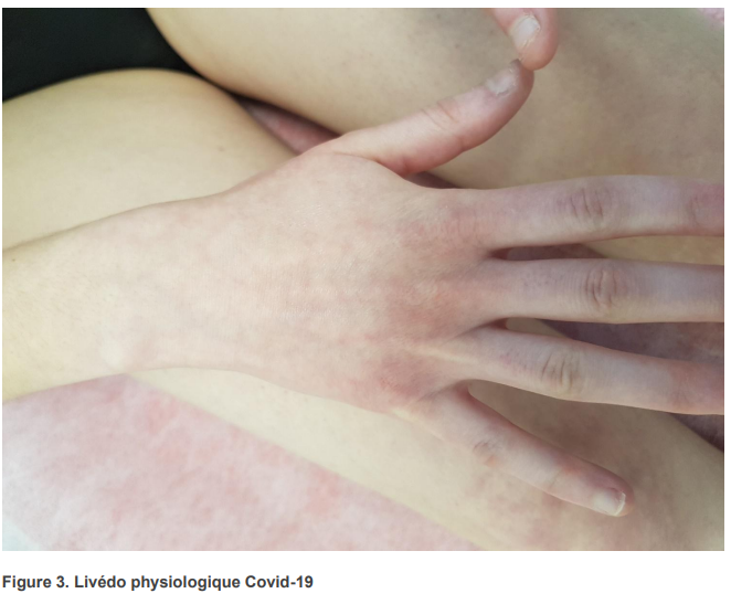 Livedo physiologique Covid19