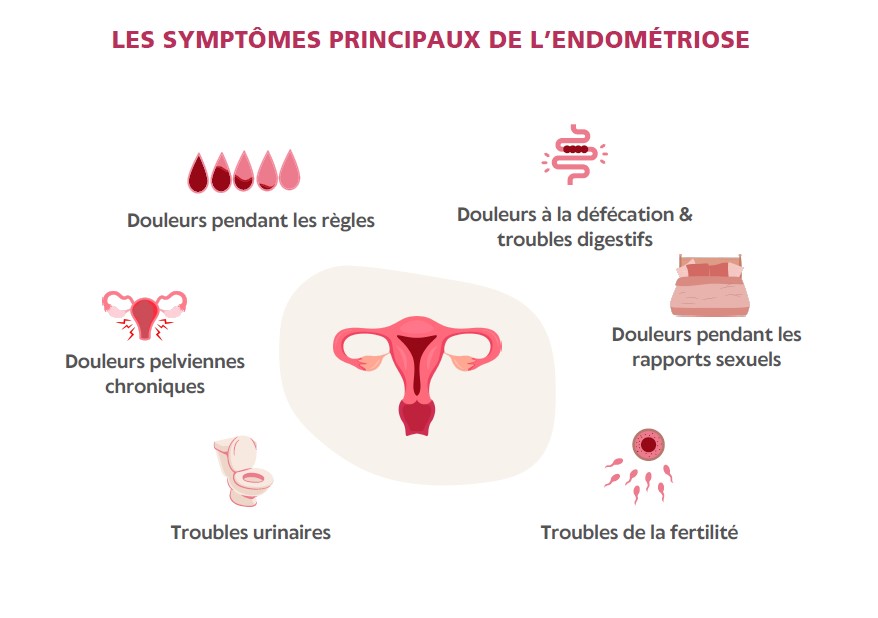 les symptômes principaux de l'endométriose