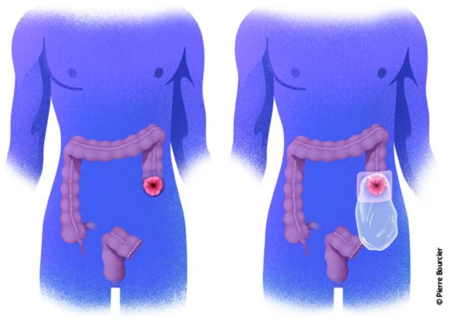 Réalisation d'une stomie digestive © Pierre Bourcier