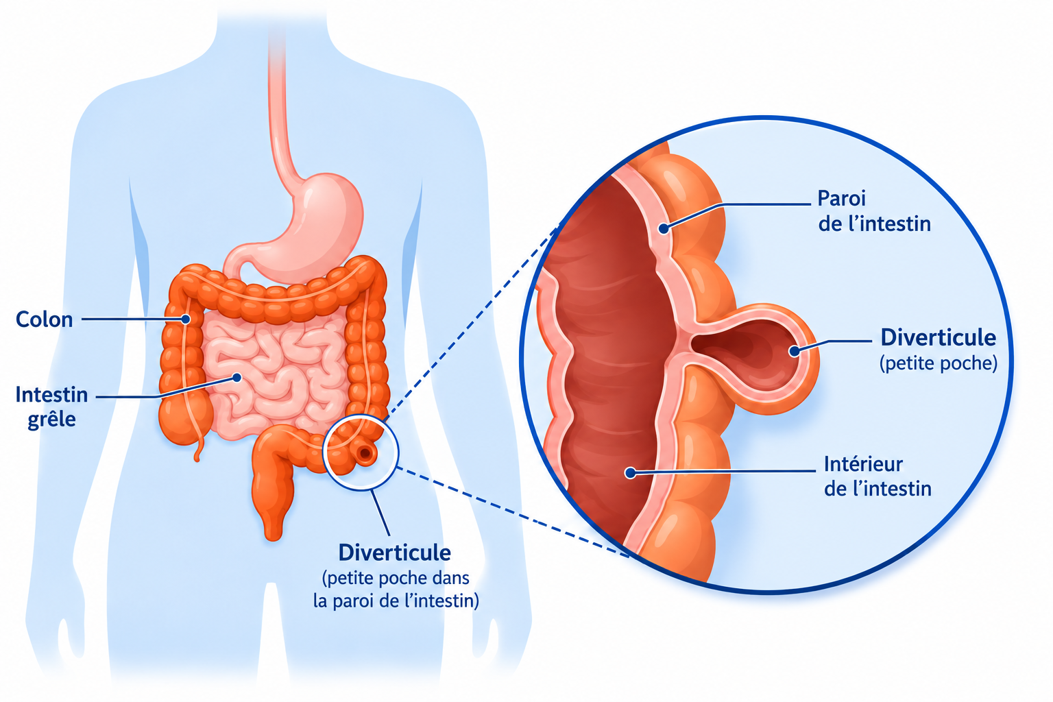 zoom diverticulite