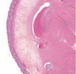 Figure 1 : Infiltration musculeuse par de l’endomètre fonctionnel